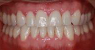 Harnick Orthodontics - Before & After