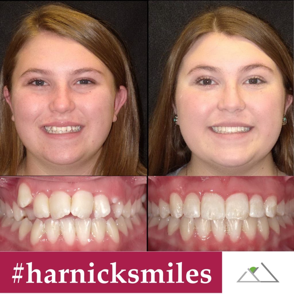 harnick ortho invisalign results