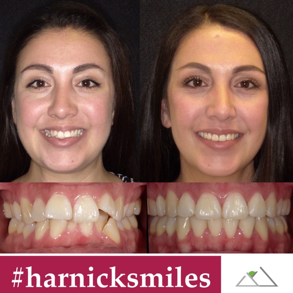 harnick ortho invisalign results