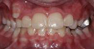 Harnick Orthodontics - Before & After