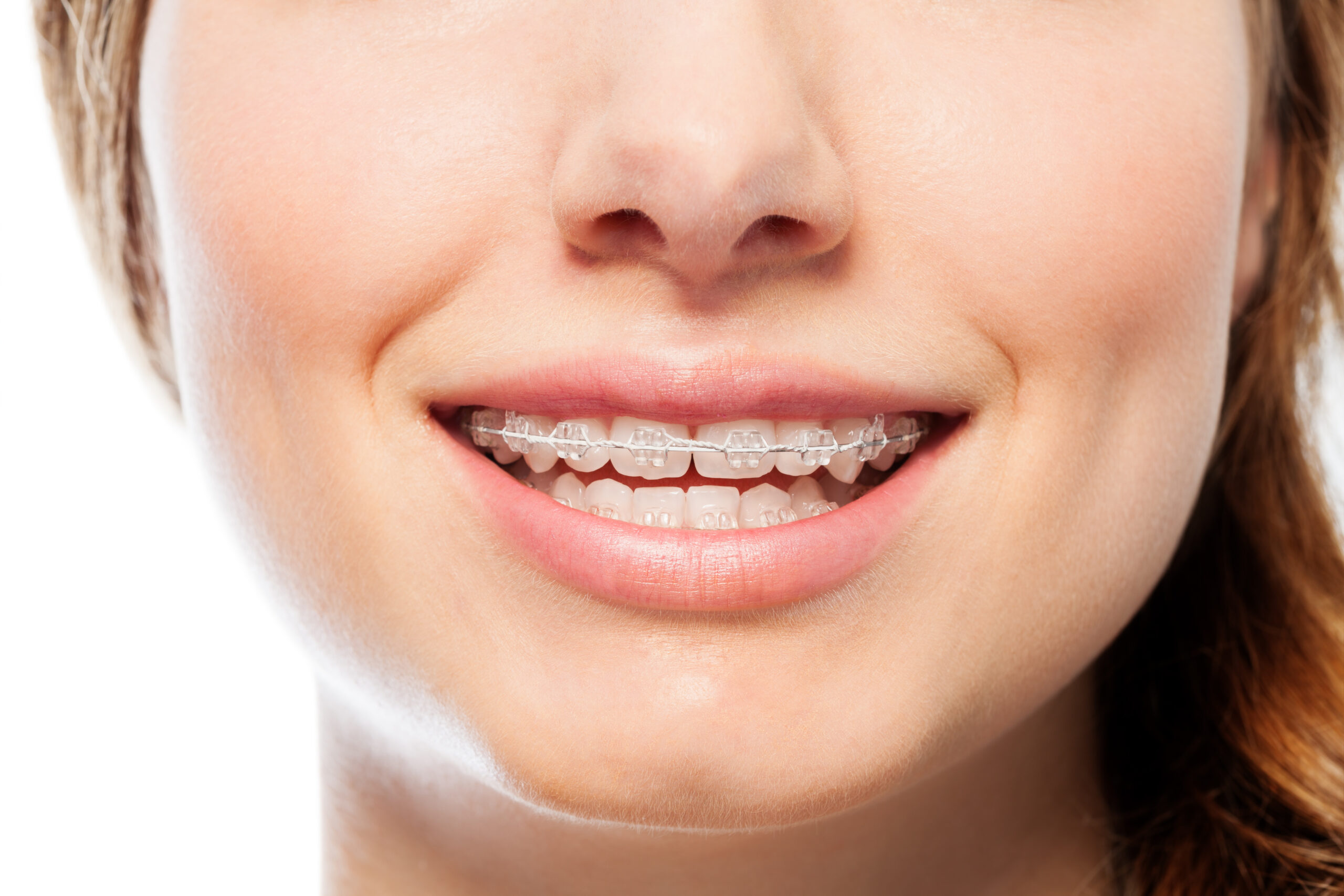 Ceramic braces