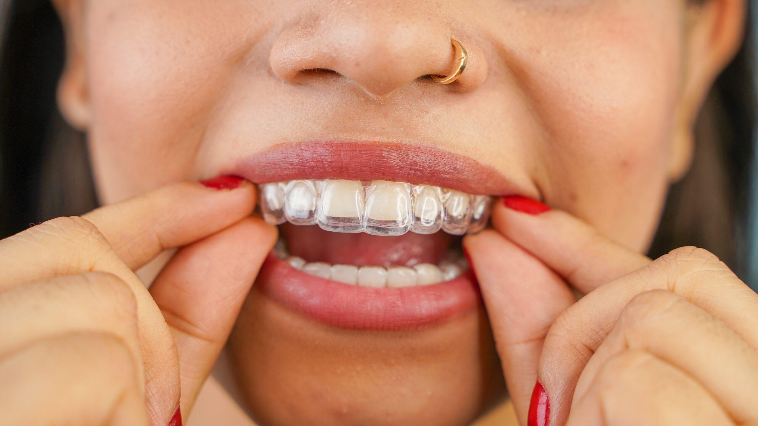 Invisalign