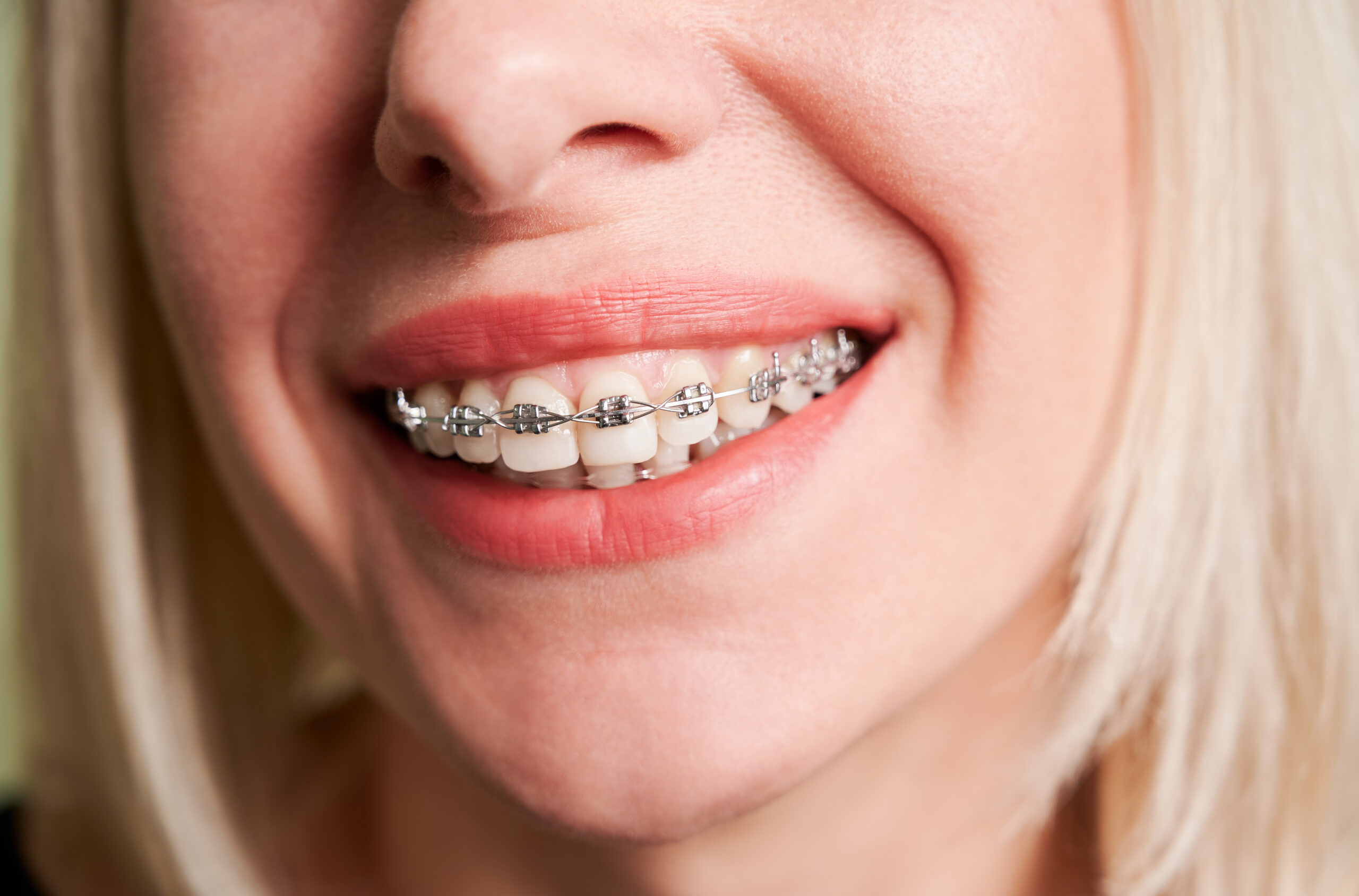Metal Braces