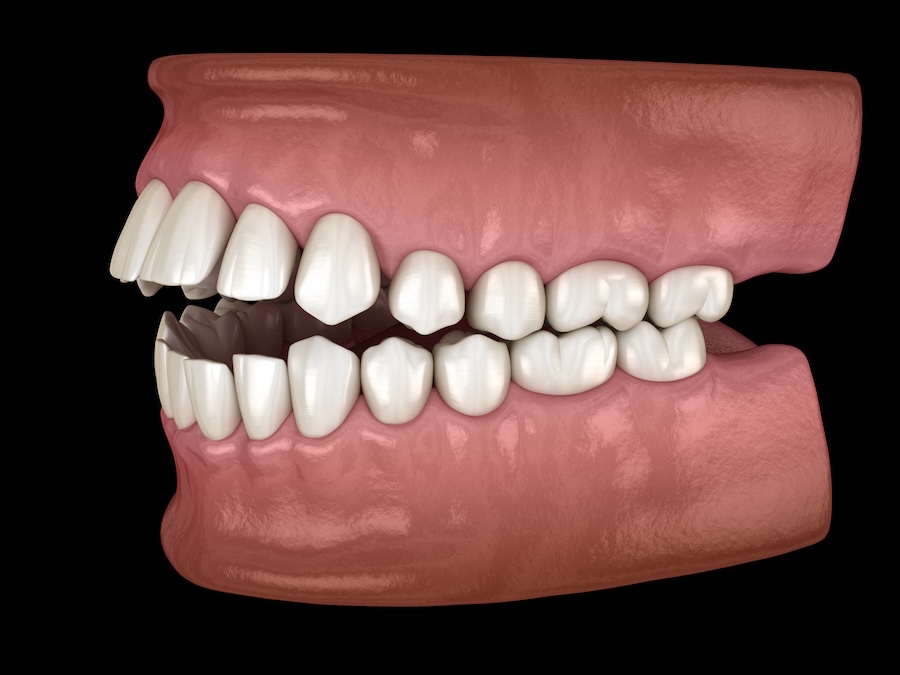 benefits of braces, orthodontic treatment for malocclusion, open bite example